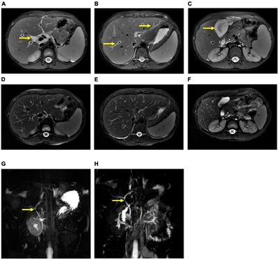 Frontiers Case Report A Case Of Severe Acute Hepatitis Of Unknown Origin   975628 Thumb 400 